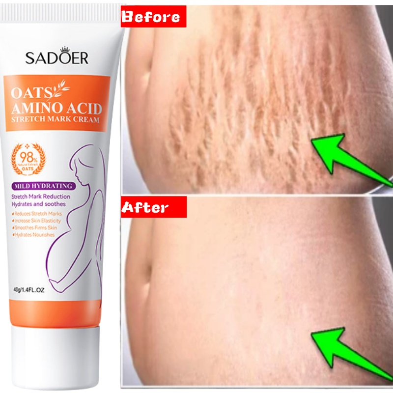 كريم إزالة علامات التمدد الدائ - مراجعة Skincare Oat وسعره